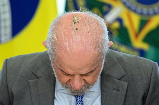 Lula inició radioterapia preventiva tras cáncer de piel
