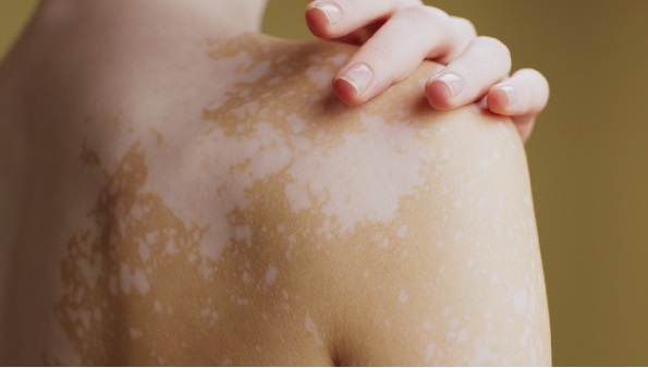 Día Mundial del Vitiligo: qué dice la ciencia sobre sus causas