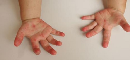 Enfermedad mano-pie-boca: síntomas y medidas para evitar contagios