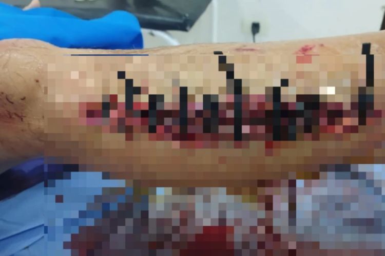 Le pusieron cintillos en vez de hilo quirúrgico: familia denuncia presunta negligencia médica